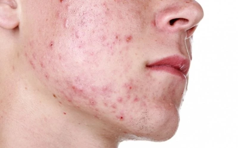 Ακμή: Αν βγάζετε σπυράκια μπορεί να φταίει το… DNA σας!